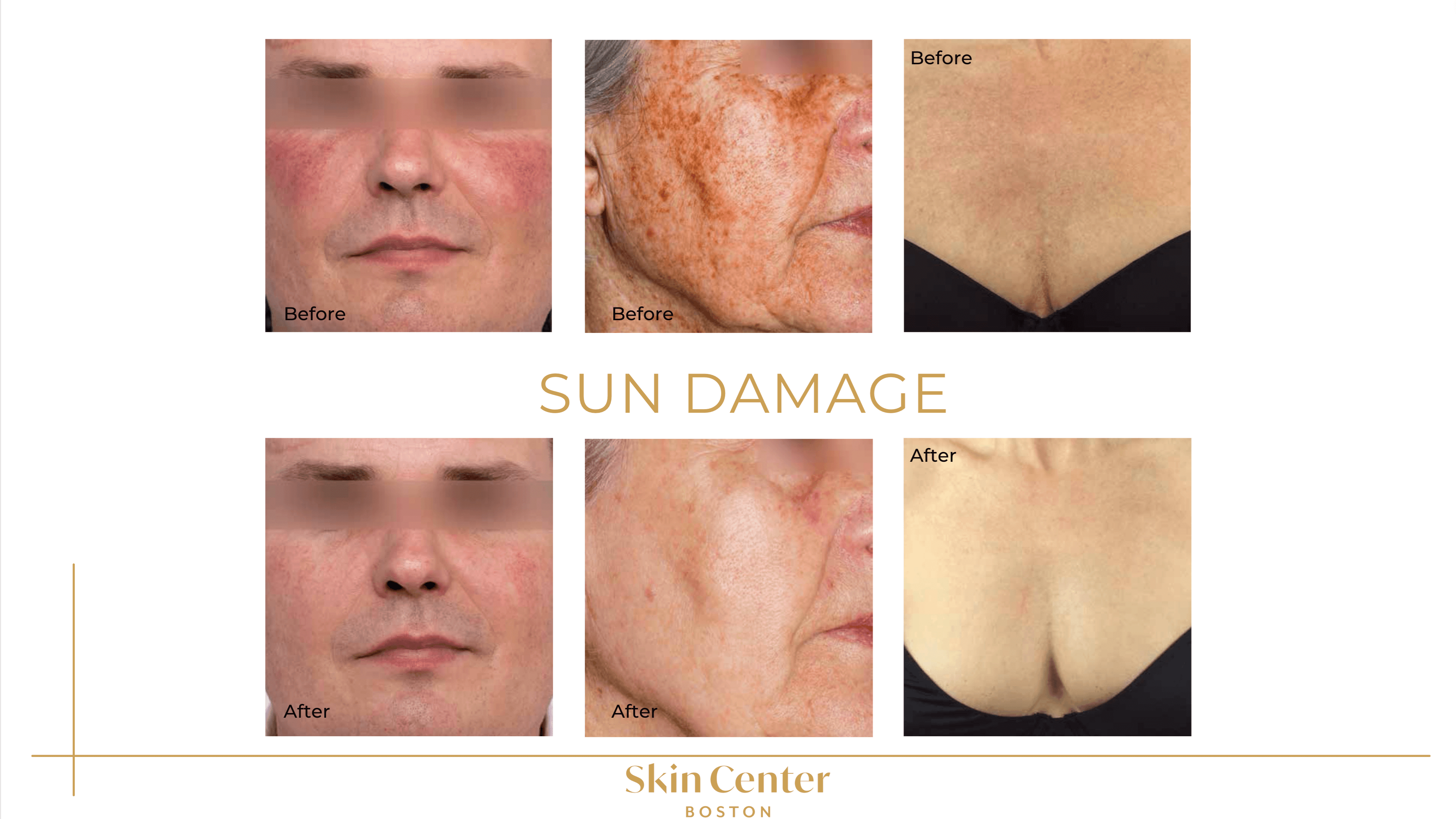 IPL - Sun Damage Before & Afte